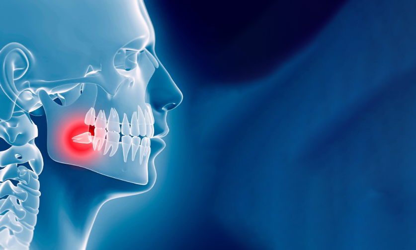 Wisdom tooth removal